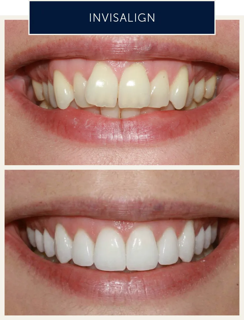 female-invisalign-treatment-before-after