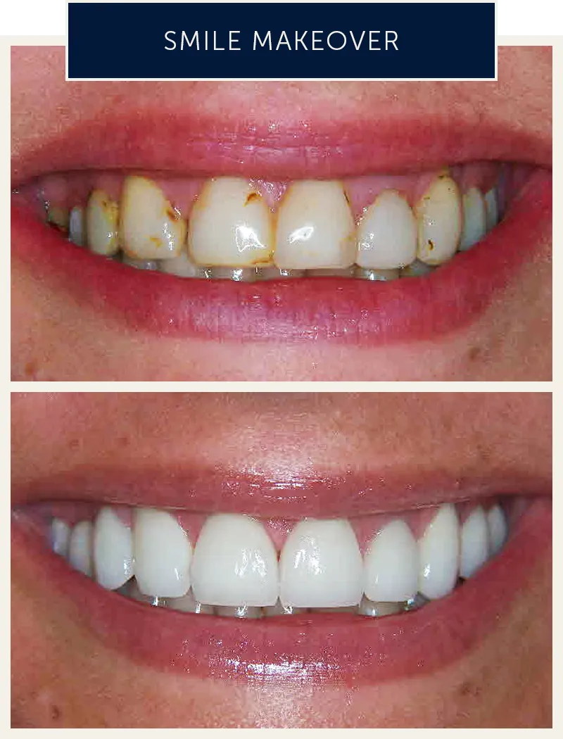 female-smile-makeover-before-after