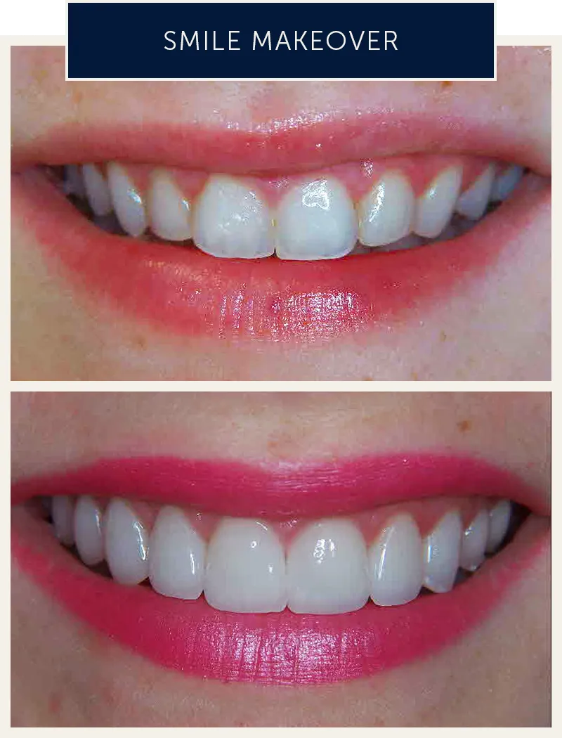 female2-smile-makeover-before-after