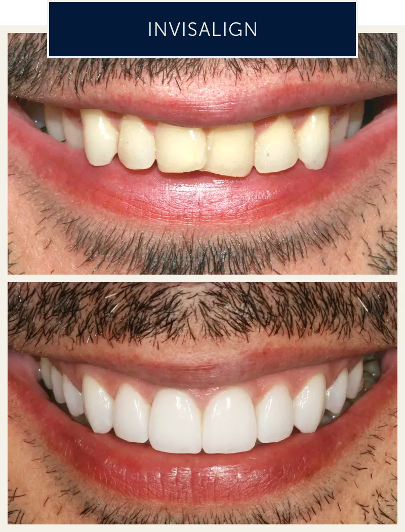 male-invisalign-treatment-before-after