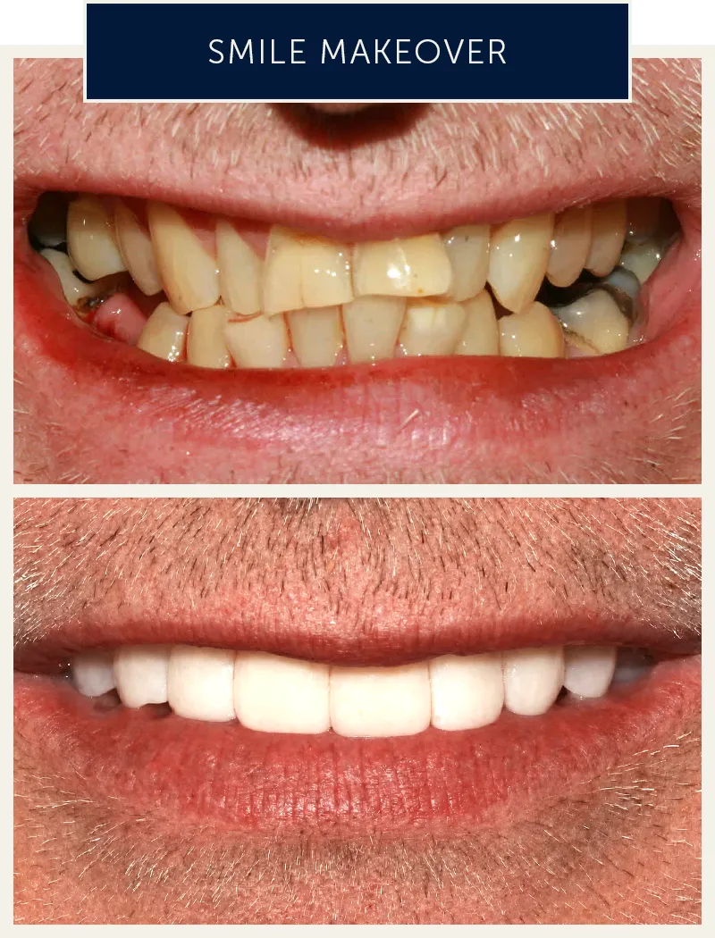 male-smile-makeover-before-after