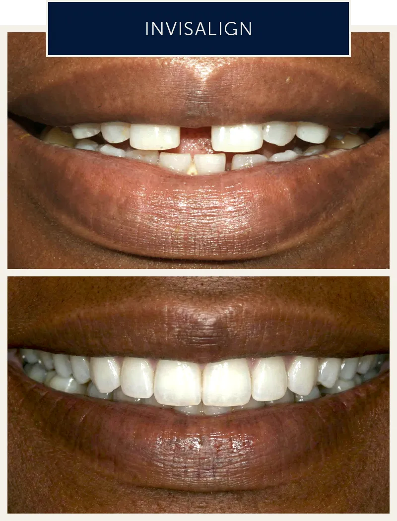 Invisalign clear aligner treatment in Kingston upon Thames