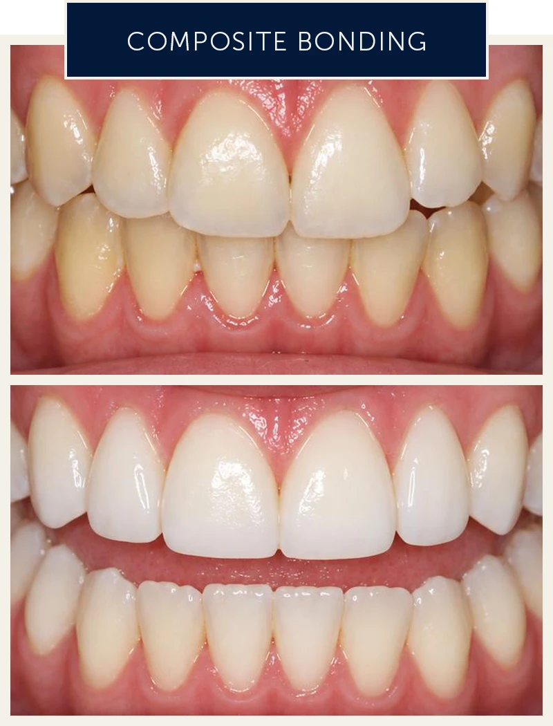 composite-bonding-before-after