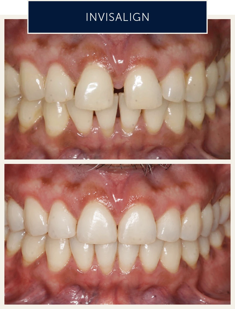 male3-invisalign-treatment-before-after